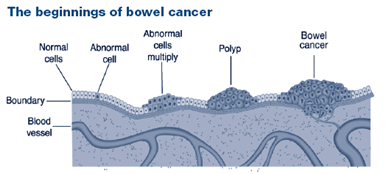 CRC pathogenesis 387 × 174