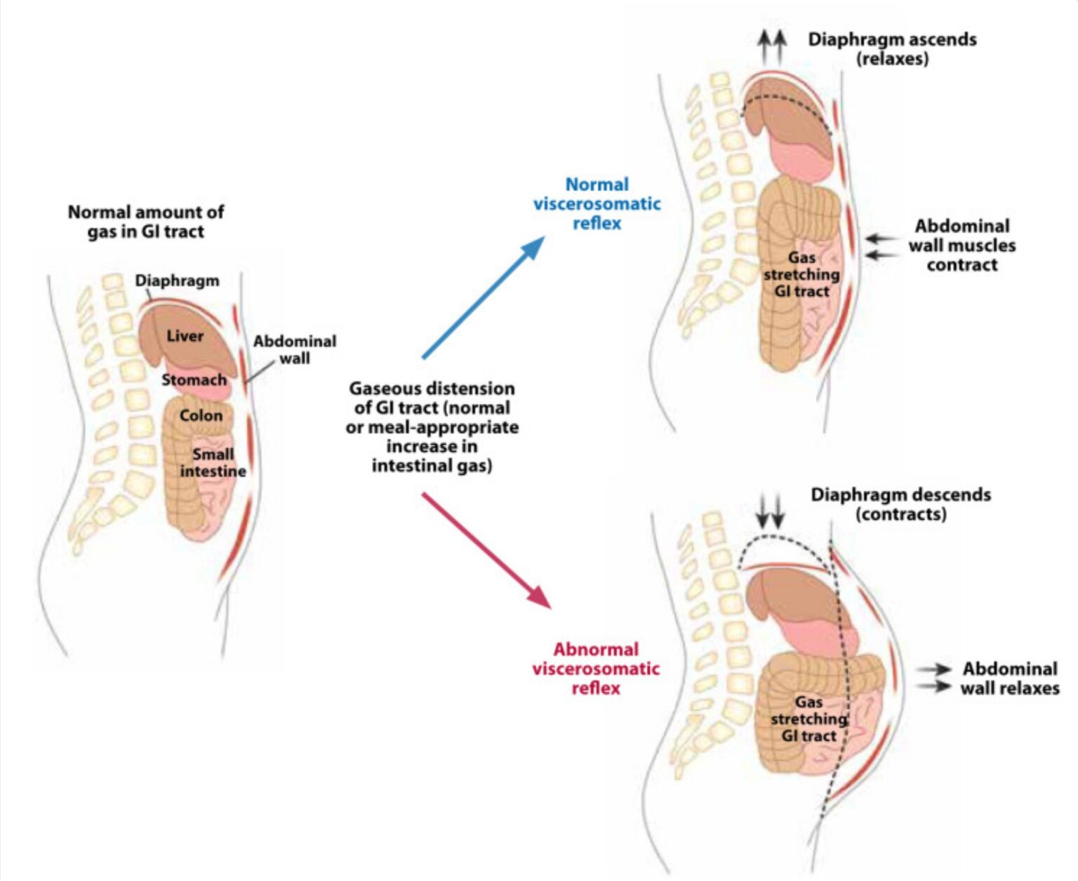 Abdominal Bloating Abdominophrenic Dyssynergia APD 