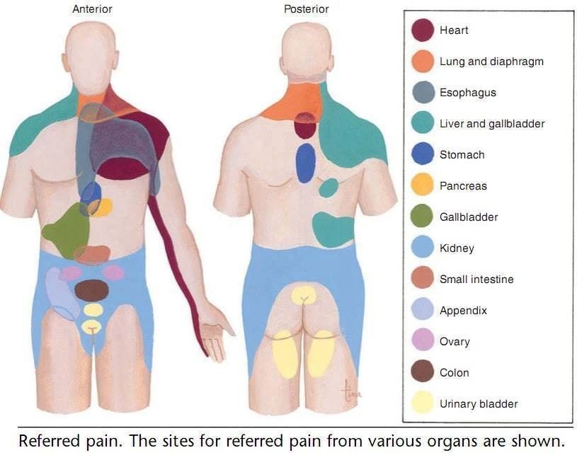 Referred pain