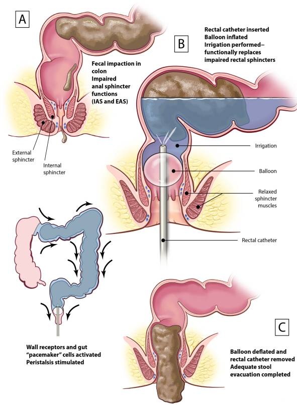 from: Rodriguez G, Kirshblum S, Thao M, McArthur M, Camilleri M. The Functional Implications of Transanal Irrigation: Insights from Pathophysiology and Clinical Studies of Neurogenic Bowel Dysfunction. J Clin Med. 2024;13(6):1527