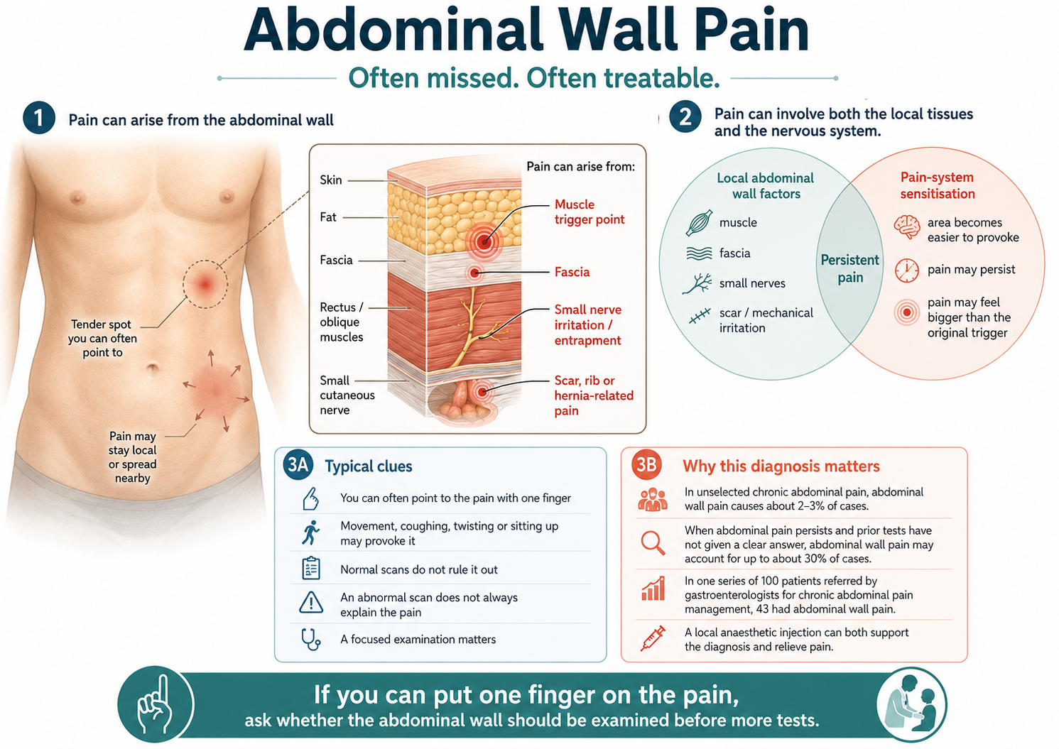 Abdominal wall pain and ACNES showing muscle, fascia, cutaneous nerves and pain sensitisation