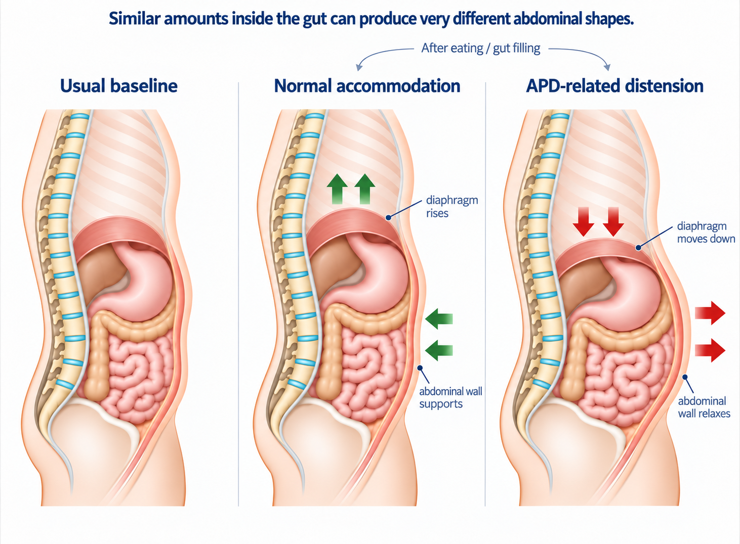 Diagram comparing usual abdominal shape, normal accommodation after gut filling, and APD-related distension, showing the diaphragm rising with abdominal wall support normally and moving down as the abdominal wall relaxes in APD.